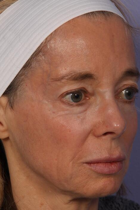 Laser Skin Resurfacing Before & After Image