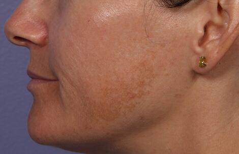 Laser Skin Resurfacing Before & After Image