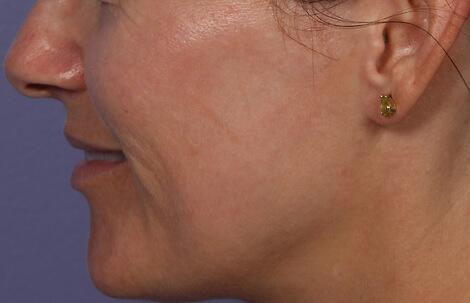 Laser Skin Resurfacing Before & After Image