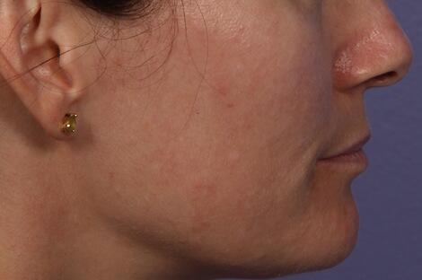 Laser Skin Resurfacing Before & After Image