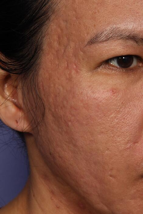 Laser Skin Resurfacing Before & After Image