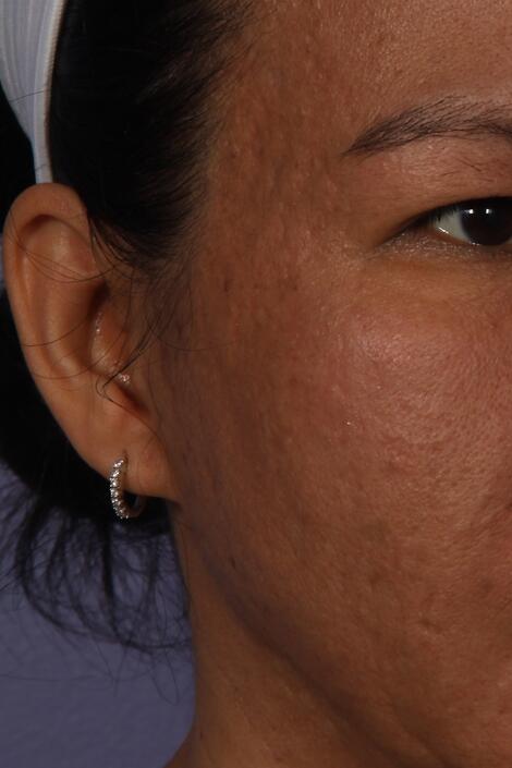 Laser Skin Resurfacing Before & After Image