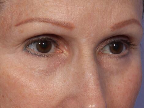 Laser Skin Resurfacing Before & After Image