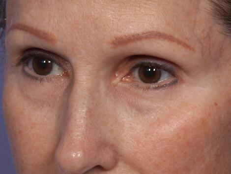 Laser Skin Resurfacing Before & After Image