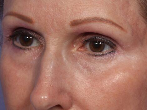 Laser Skin Resurfacing Before & After Image