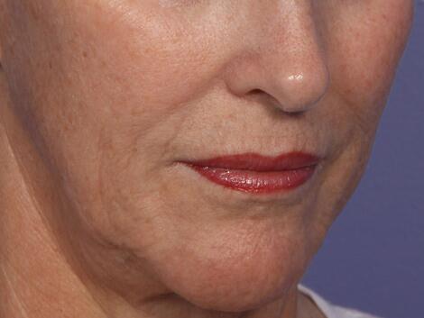 Laser Skin Resurfacing Before & After Image