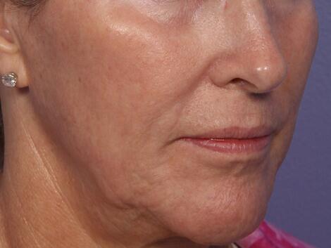 Laser Skin Resurfacing Before & After Image