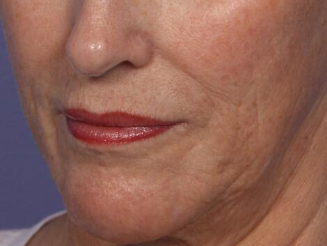 Laser Skin Resurfacing Before & After Image