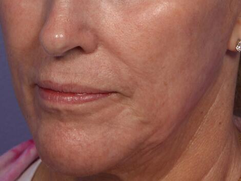 Laser Skin Resurfacing Before & After Image