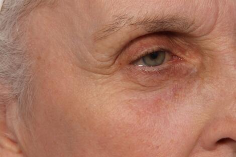 Laser Skin Resurfacing Before & After Image