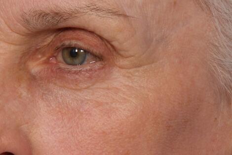 Laser Skin Resurfacing Before & After Image