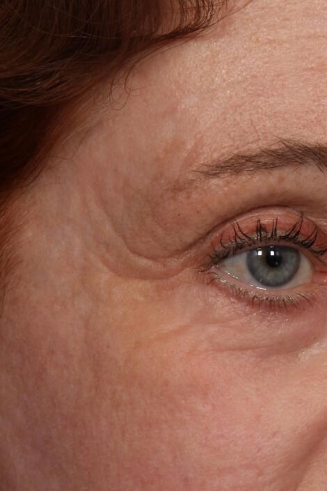 Laser Skin Resurfacing Before & After Image