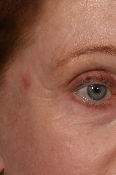 Laser Skin Resurfacing Before & After Image