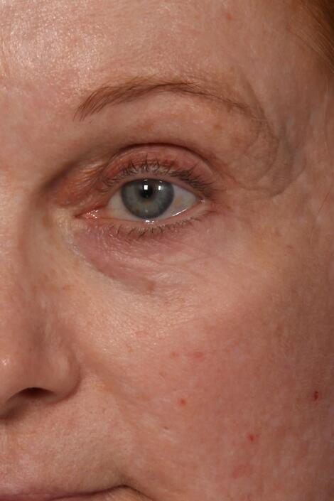 Laser Skin Resurfacing Before & After Image