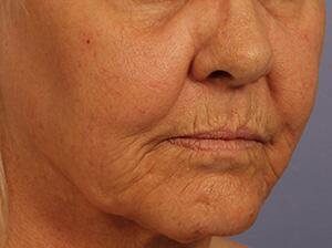 Laser Skin Resurfacing Before & After Image