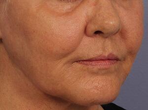 Laser Skin Resurfacing Before & After Image