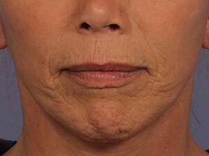 Laser Skin Resurfacing Before & After Image