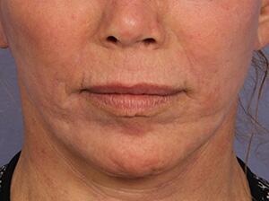 Laser Skin Resurfacing Before & After Image