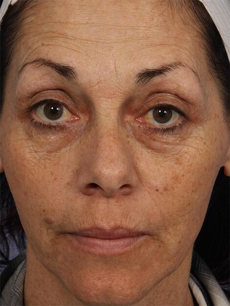 Laser Skin Resurfacing Before & After Image