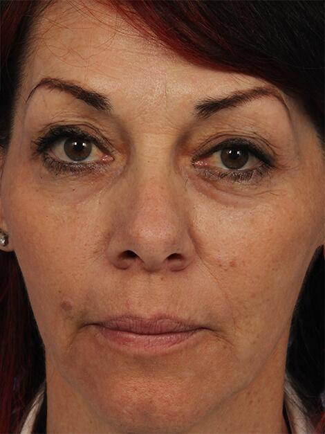 Laser Skin Resurfacing Before & After Image