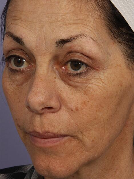 Laser Skin Resurfacing Before & After Image