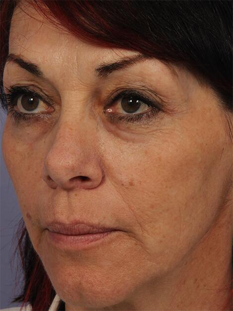 Laser Skin Resurfacing Before & After Image