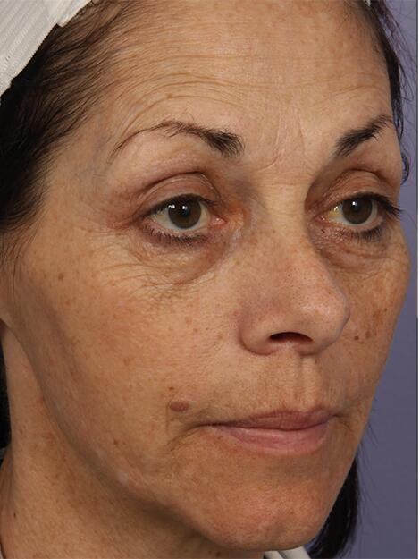 Laser Skin Resurfacing Before & After Image