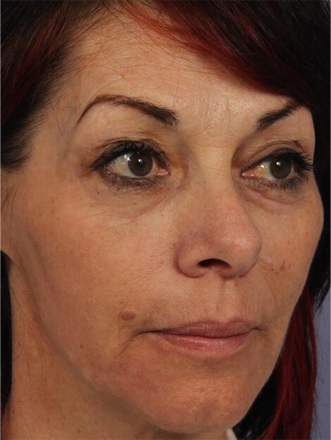 Laser Skin Resurfacing Before & After Image