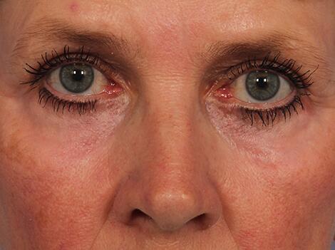 Laser Skin Resurfacing Before & After Image