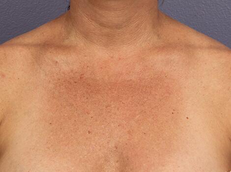 Laser Skin Resurfacing Before & After Image