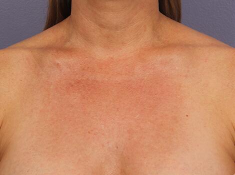 Laser Skin Resurfacing Before & After Image