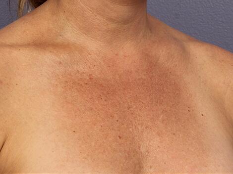 Laser Skin Resurfacing Before & After Image