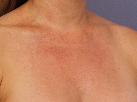 Laser Skin Resurfacing Before & After Image