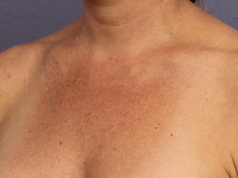 Laser Skin Resurfacing Before & After Image