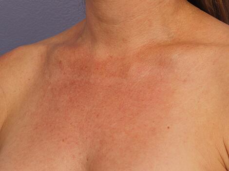 Laser Skin Resurfacing Before & After Image