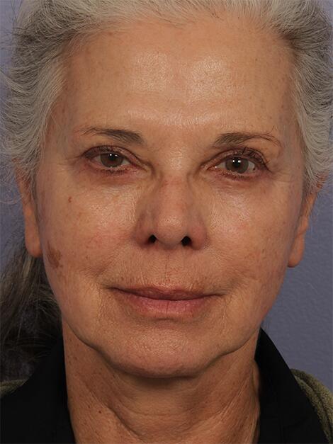 Laser Skin Resurfacing Before & After Image