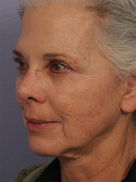 Laser Skin Resurfacing Before & After Image