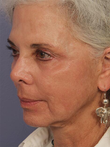 Laser Skin Resurfacing Before & After Image