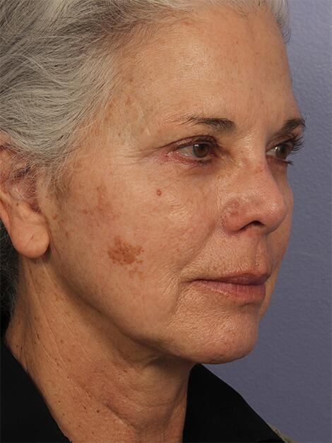 Laser Skin Resurfacing Before & After Image