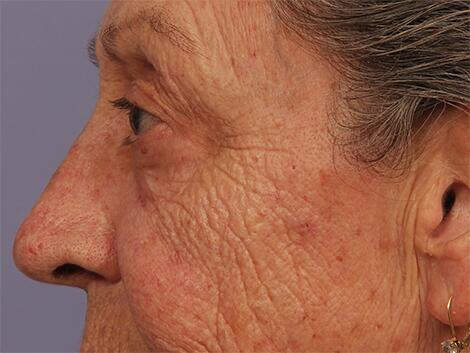 Laser Skin Resurfacing Before & After Image