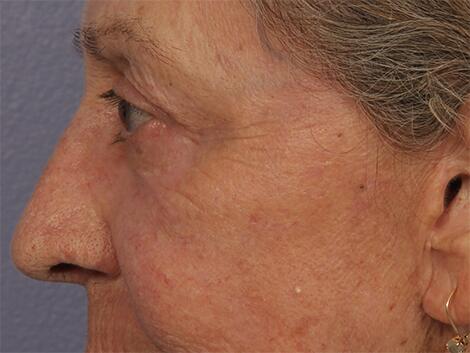 Laser Skin Resurfacing Before & After Image