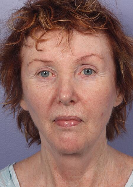 Laser Skin Resurfacing Before & After Image