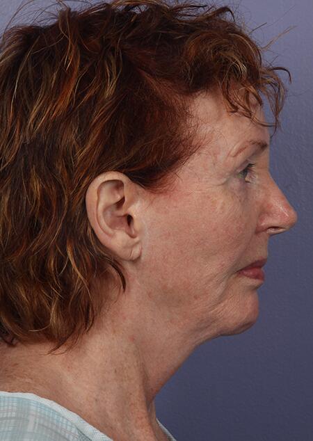 Laser Skin Resurfacing Before & After Image