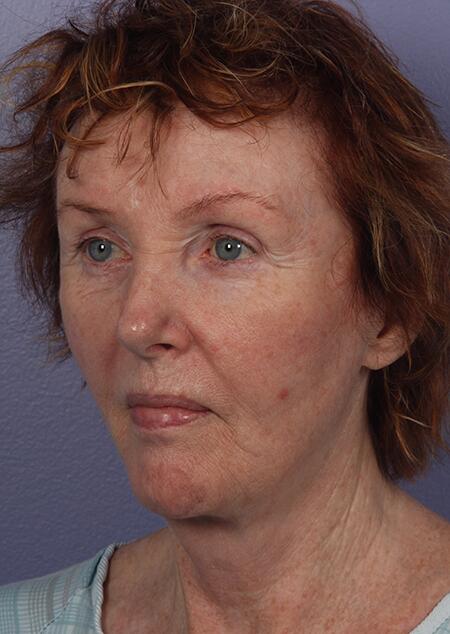 Laser Skin Resurfacing Before & After Image