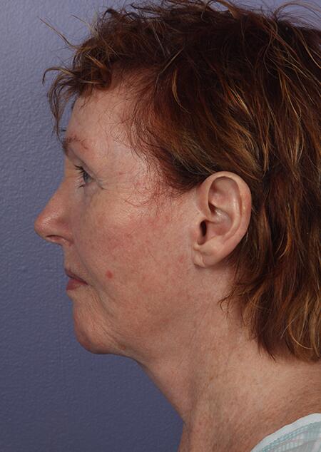 Laser Skin Resurfacing Before & After Image