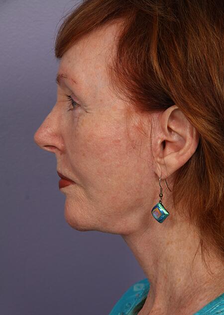 Laser Skin Resurfacing Before & After Image