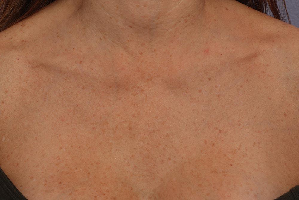 Laser Skin Resurfacing Before & After Image