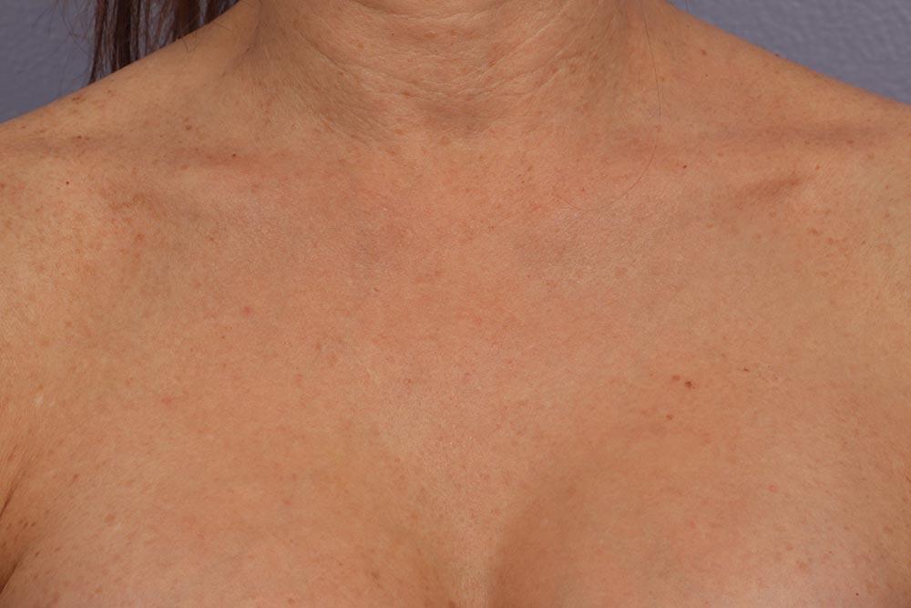 Laser Skin Resurfacing Before & After Image