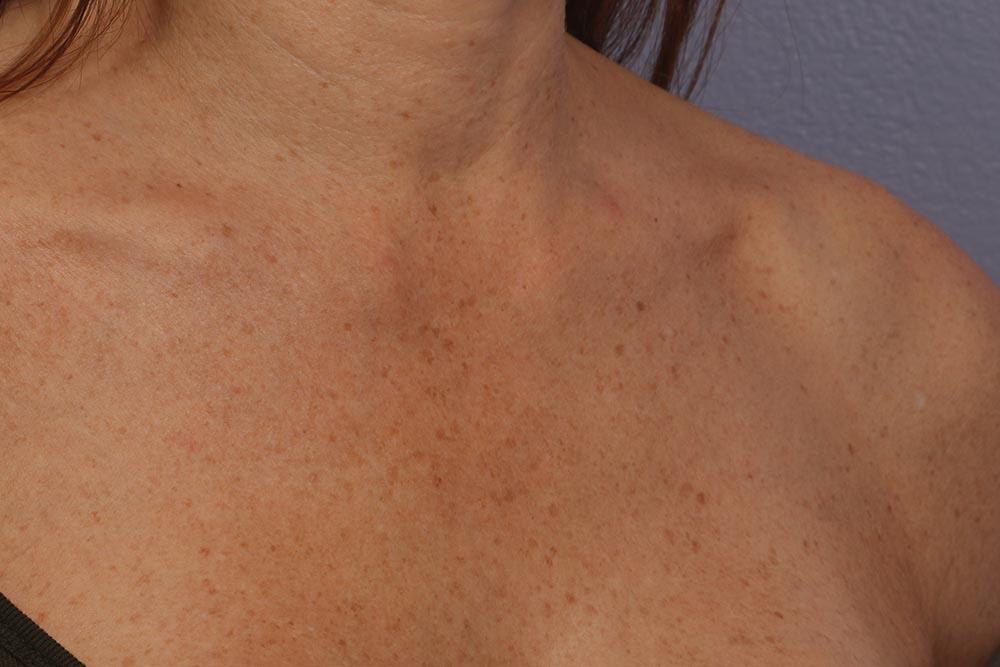 Laser Skin Resurfacing Before & After Image