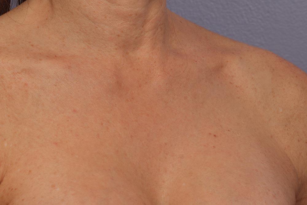 Laser Skin Resurfacing Before & After Image